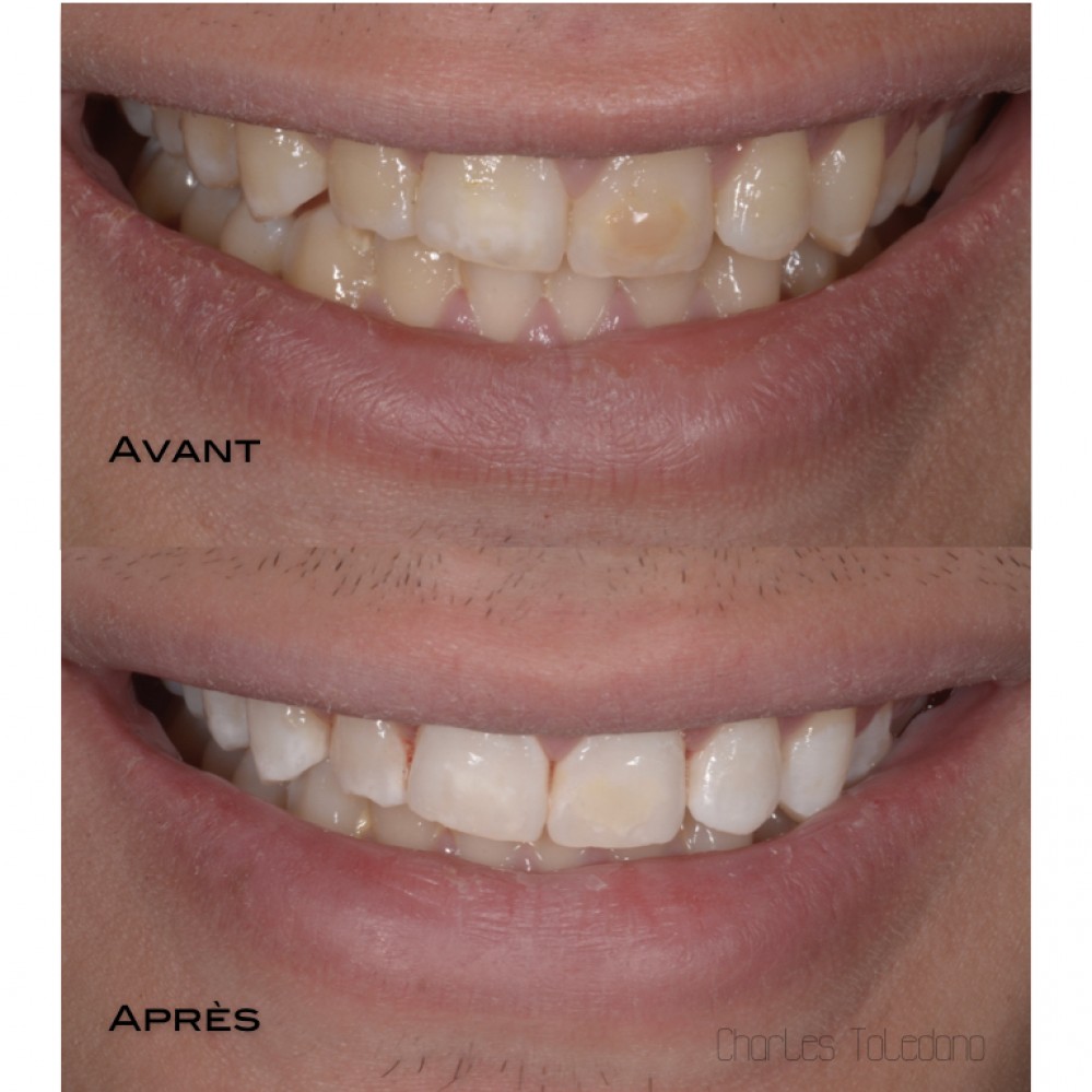 L’érosion infiltration pour traiter les taches blanches - Cabinet ...
